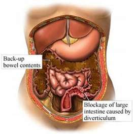 colon cleansing