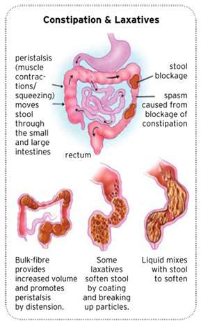 constipation laxativesremedies